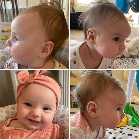 Displacement of the ipsilateral ear is anterior in deformational <b>plagiocephaly</b> and posterior in synostosis. . Frontal bossing in babies